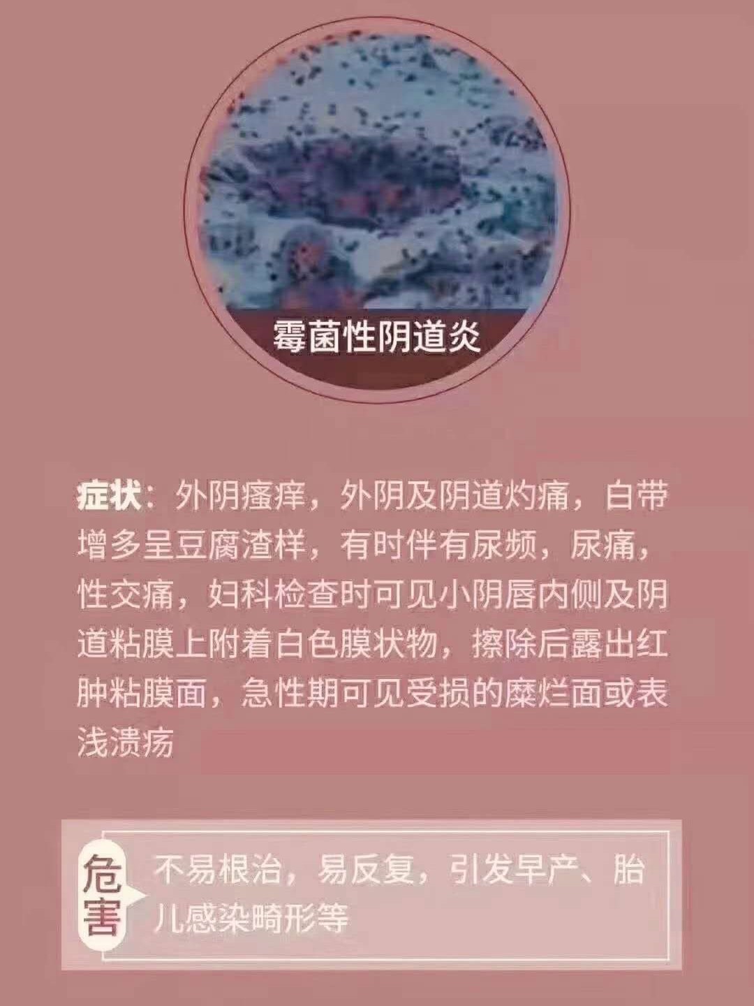 霉菌性陰炎癥狀表現(xiàn)及其影響，深入了解與應(yīng)對(duì)，霉菌性陰炎的癥狀表現(xiàn)、影響及應(yīng)對(duì)之策