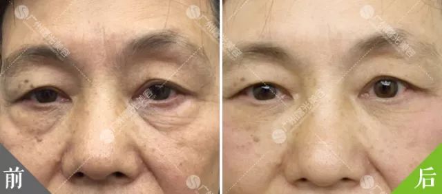 如何有效消除大眼袋，方法與策略全解析，消除大眼袋的有效方法與策略全解析