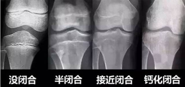 自測(cè)骨骼閉合小方法，簡(jiǎn)單有效的判斷骨骼發(fā)育狀況，自測(cè)骨骼閉合小技巧，輕松判斷骨骼發(fā)育狀況