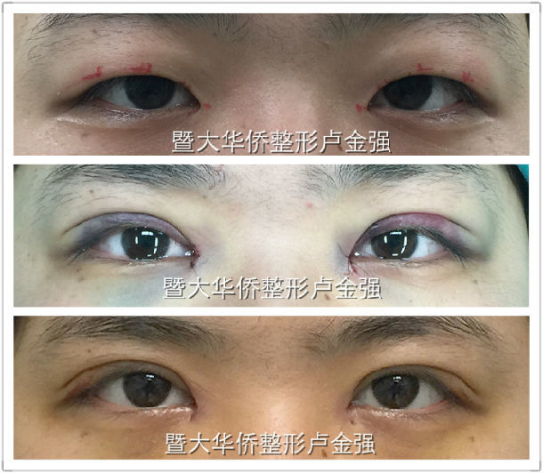關于開眼角手術(shù)價格表，深入了解與全面解析，開眼角手術(shù)價格表詳解，全面了解手術(shù)費用與解析過程