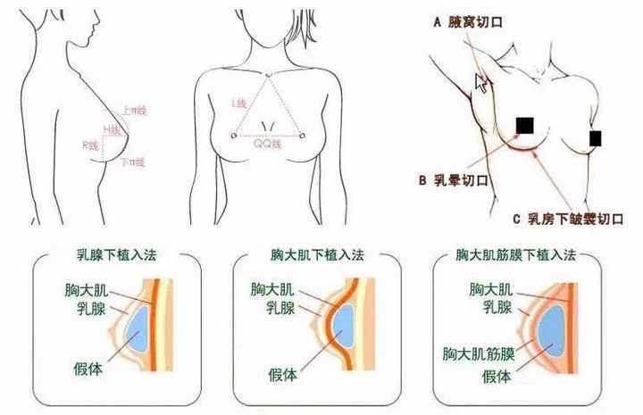 豐胸，探尋最安全最有效的豐胸方法，探尋最安全有效的豐胸方法秘籍