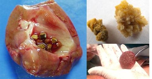 如何快速排出腎結(jié)石——全面的解決方案，全面解決方案，如何迅速排除腎結(jié)石