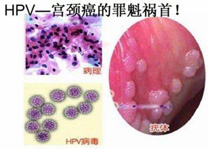 打了兩針才發(fā)現(xiàn)自己HPV感染，如何應(yīng)對(duì)與預(yù)防，應(yīng)對(duì)與預(yù)防HPV感染，發(fā)現(xiàn)感染后的兩針之路