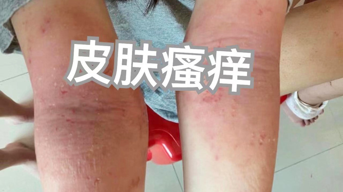 過敏性皮炎圖片，了解、識(shí)別與管理，過敏性皮炎圖片詳解，識(shí)別、管理與應(yīng)對(duì)之道