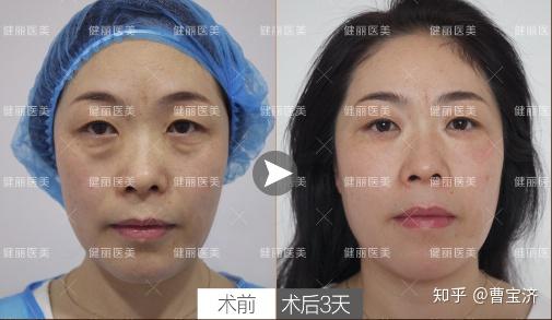 如何消除眼袋，告別眼部疲憊的實用指南，眼袋消除與眼部疲憊緩解，實用指南