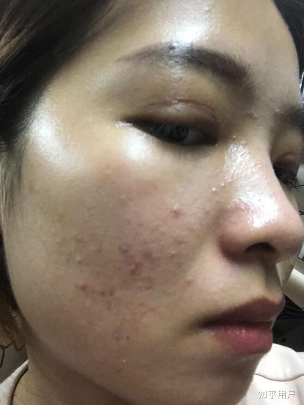 去閉口粉刺最有效的方法，全面解析與實用建議，全面解析去閉口粉刺的有效方法與實用建議