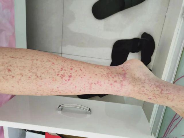 紫癜是一種什么病，深入了解與應(yīng)對方法，紫癜詳解，病癥認(rèn)知與應(yīng)對之策