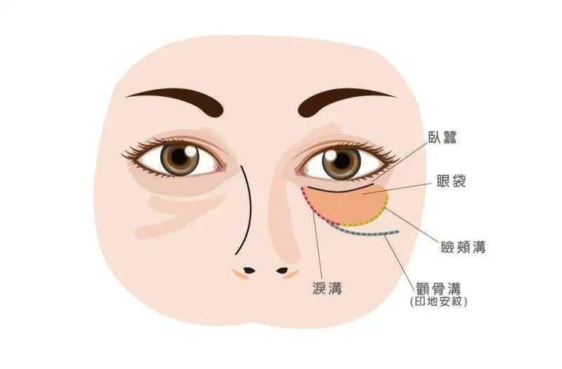 揭秘眼袋成因與消除方法，專業(yè)指南助你告別眼部困擾，揭秘眼袋成因與消除秘籍，專業(yè)指南助你告別眼部煩惱