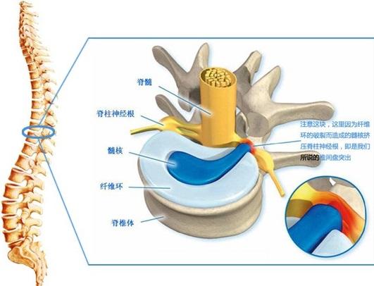腰椎間盤突出能自愈嗎？解析與應對方法，腰椎間盤突出解析，能否自愈及應對方法