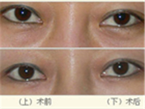 如何有效去除眼袋，多種方法助你煥發(fā)青春光彩，多種方法助你有效去除眼袋，重拾青春光彩