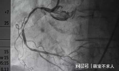 做完心臟造影后的心理反思，理解并面對我們的恐懼與后悔，心臟造影后的心理反思，面對恐懼與后悔的內(nèi)心剖析