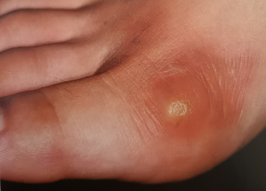 雞眼的癥狀與圖片展示，了解雞眼長什么樣子的全面解析，雞眼癥狀詳解，圖片展示與全面解析