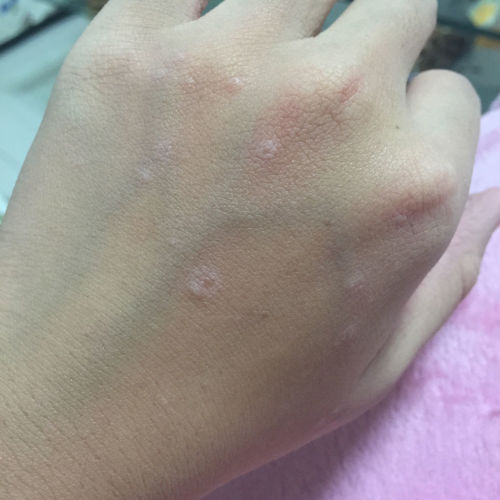 梅毒疹一看就知道，深度解析梅毒疹的癥狀與診斷，深度解析梅毒疹的癥狀與診斷，一眼識(shí)別梅毒疹特征