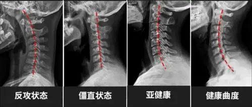 頸椎病的癥狀，了解、預防與應對，頸椎病癥狀解析，了解、預防與應對策略