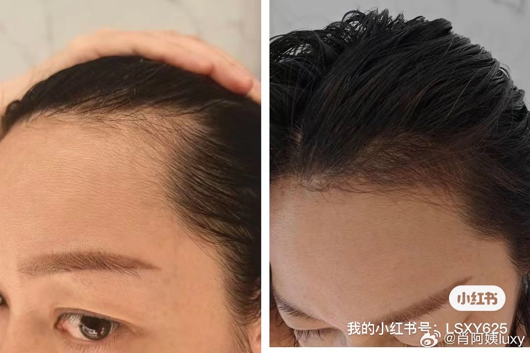 如何養(yǎng)回發(fā)際線，重拾你的自信與美麗，如何重塑發(fā)際線，找回自信與美麗風(fēng)采
