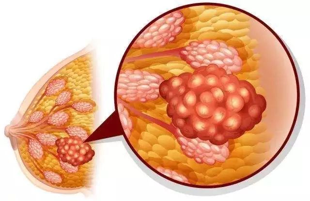 乳房中部出現(xiàn)一圈硬塊，原因解析與應(yīng)對建議，乳房中部硬塊解析，成因及應(yīng)對建議