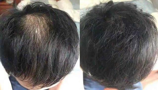 頭頂頭發(fā)稀少怎么補救，多種方法助你重獲濃密秀發(fā)，頭頂頭發(fā)稀少怎么辦？多種方法助你恢復濃密秀發(fā)