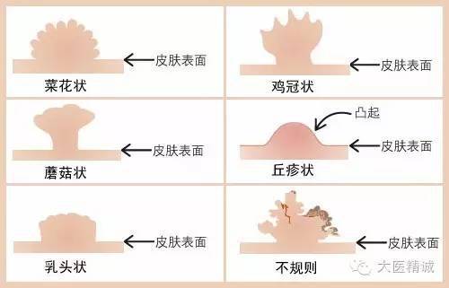 尖濕銳尖疣自查方法與注意事項(xiàng)，尖濕銳尖疣自查指南及注意事項(xiàng)