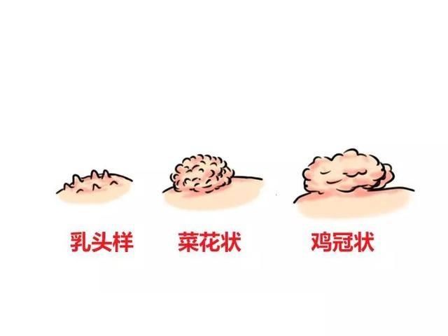 如何判斷皮膚上的異常是否為疣？全面解析疣的癥狀與診斷方法，全面解析，皮膚異常是否為疣的癥狀與診斷方法指南