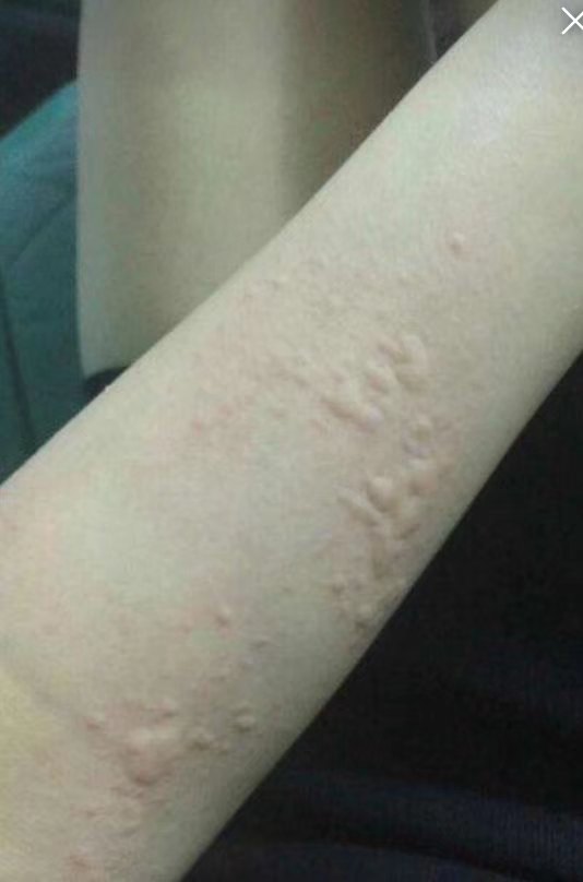 蕁麻疹是怎么引起的，蕁麻疹的成因解析