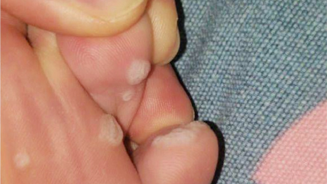 腳底長了像水泡一樣的東西很癢，原因解析及應(yīng)對方法，腳底水泡癢癥，原因解析與應(yīng)對方法