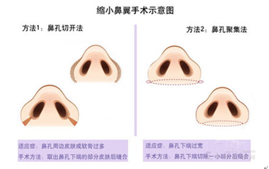 鼻綜合手術(shù)費(fèi)用詳解，究竟需要多少錢？，鼻綜合手術(shù)費(fèi)用全面解析，了解鼻整形手術(shù)所需成本