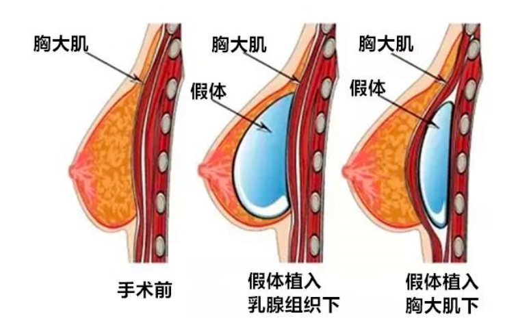 假體隆胸可以一輩子不用取出來嗎？全面解析隆胸假體的長(zhǎng)期安全性，全面解析隆胸假體的長(zhǎng)期安全性，是否可永久放置不用取出？