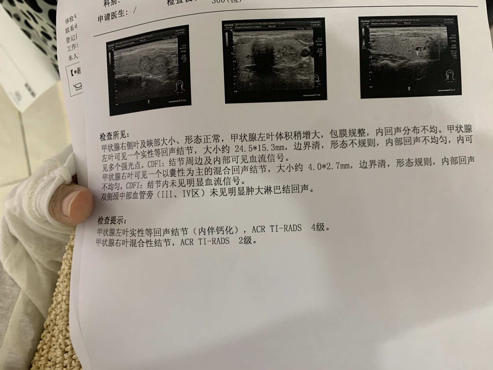 甲狀腺結(jié)節(jié)大小多少mm以上建議手術(shù)？全面解讀甲狀腺結(jié)節(jié)手術(shù)標(biāo)準(zhǔn)與注意事項(xiàng)，甲狀腺結(jié)節(jié)手術(shù)標(biāo)準(zhǔn)與注意事項(xiàng)，何時(shí)需手術(shù)？甲狀腺結(jié)節(jié)大小臨界點(diǎn)解析