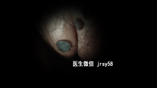 男性尖銳濕疣的自我治療指南，男性尖銳濕疣自我治療指南，實用方法與技巧